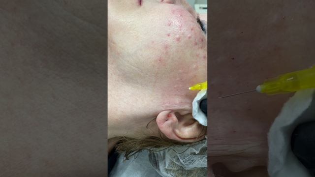 Семинар - обучение «Мезотерапия. Биоревитализация». смотреть онлайн