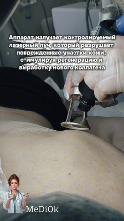 Лазерная шлифовка спины