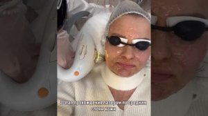 Как происходит удаление пигментных пятен на лазере М22