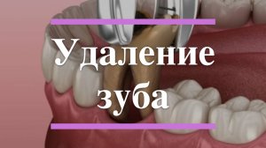 🛠 Как проходит удаление зуба — без боли и паники