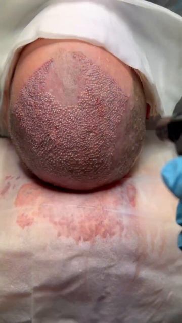 Пересадка волос после отлично операции #пересадкавол? смотреть онлайн