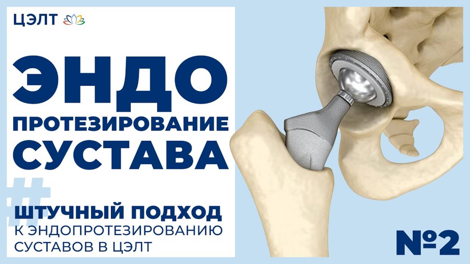 🌟 Эндопротезирование сустава. Штучный подход к эндопротезированию суставов. ЦЭЛТ.
