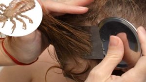 Как избавиться от вшей и гнид волос и головы, предотвр?