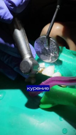 Стоматологи не предупреждают, но пломба может вот так потемнеть| Замена старых реставраций