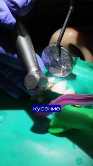 Стоматологи не предупреждают, но пломба может вот так потемнеть| Замена старых реставраций