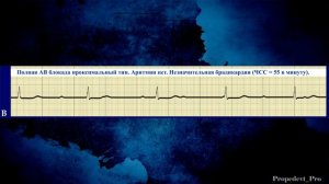 Слушаем звуки сердца (4). Аускультация сердца при аритм