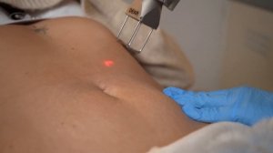 Лазерная шлифовка живота от растяжек в Санкт-Петербур