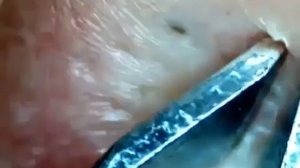 Удаление комедона ушной раковины / жирные угри