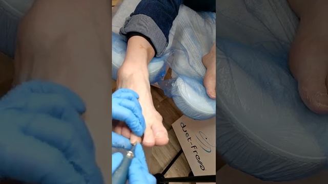 Особенности обработки пальцев в сезон закрытой обуви смотреть онлайн