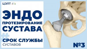 🙆 Эндопротезирование сустава. Срок службы эндопротезированных суставов. ЦЭЛТ.