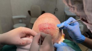 Последний этап в пересадке волос- вживление графтов❗️