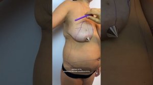 КОМПЛЕКСНАЯ ОПЕРАЦИЯ: ВЕКИ + ЛИЦО + ГРУДЬ + ЖИВОТ. Доктор Карапетян