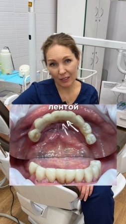 🦷Эстетическое шинирование зубов в "Персона Дент" ✨🦷