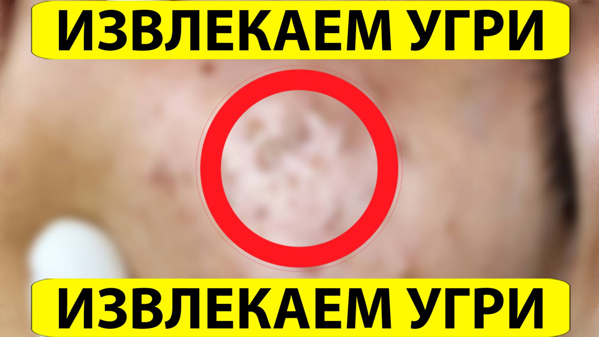 Удаление черных точек. Выдавливание прыщей. Акне и комедоны. Чистка Лица.