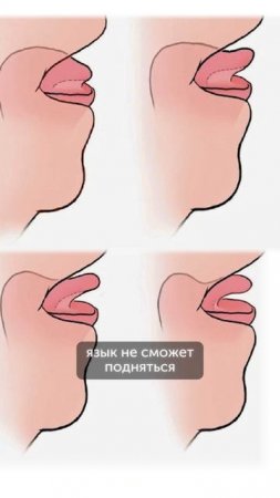 Важность эластичности уздечки языка #еленавитальевнатерентьева  #уздечка