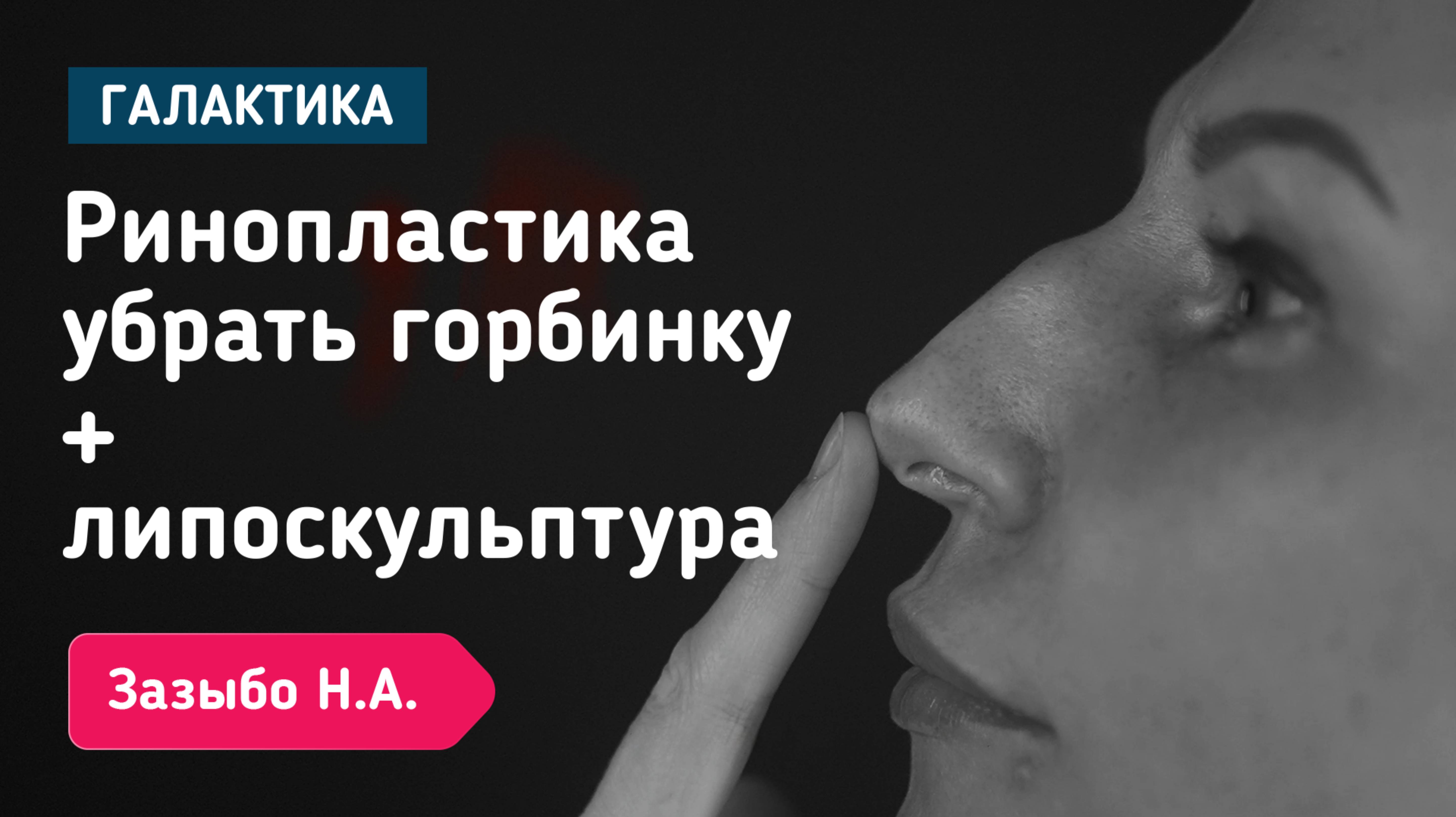 Трое детей и новое “я”: ринопластика + липоскульптура от Николая Зазыбо