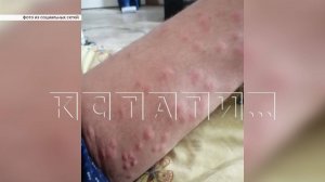 Черви-церкарии нападают в воде на купающихся в озёрах Нижнего Новгорода