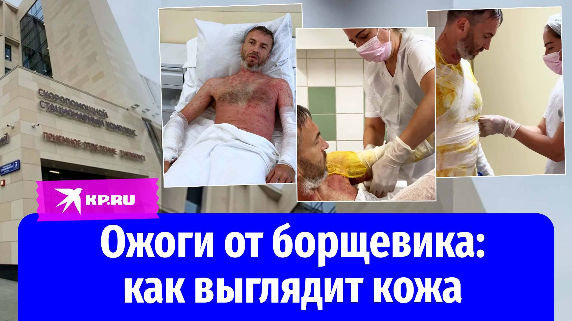 Пациент «Склифа» показал кожу после ожогов от борщевика