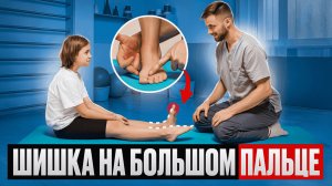 ШИШКА НА БОЛЬШОМ ПАЛЬЦЕ НОГИ / ВЫПИРАЮЩАЯ КОСТЬ  / ПРИЧИНЫ /  КОРРЕКЦИЯ С ПОМОЩЬЮ УПРАЖНЕНИЙ