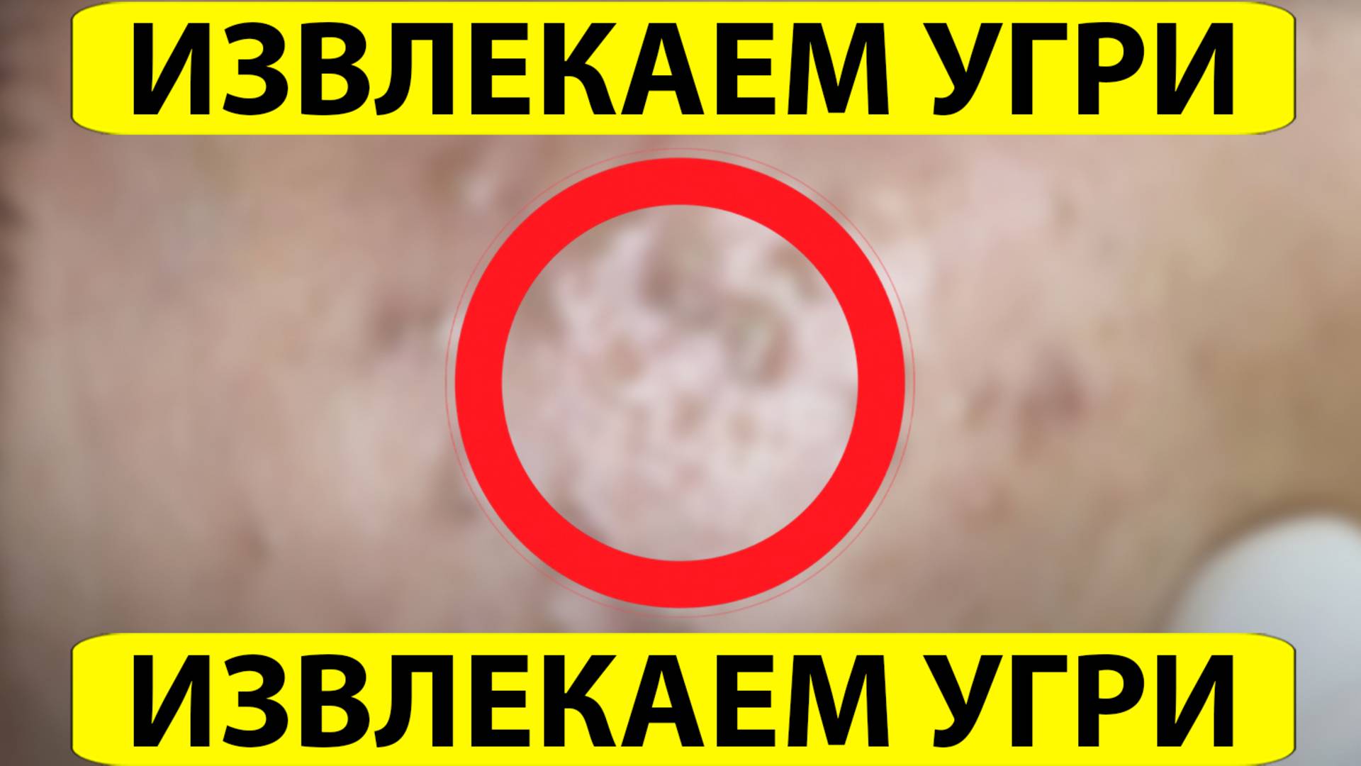 Удаление черных точек. Выдавливание прыщей. Акне и комедоны. Чистка Лица.
