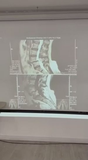 Семинар в г.Казань - 1 ступень, июнь 2025 (часть 5) Листез поясничного отдела