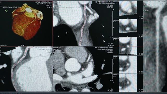 КТ Коронарография в КБ «РЖД Медицина» в г Пенза смотреть онлайн