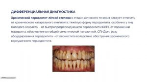 Острый пародонтит