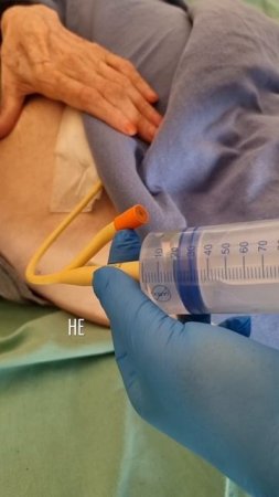 Как промывать цистостому? Самый популярный вопрос при выписке из больницы.