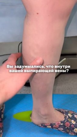 Не откладывай лечение вен!!!