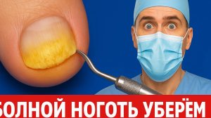 Счистили ногти-камушки на ноге бабули. Чистка ногтей. Подолог