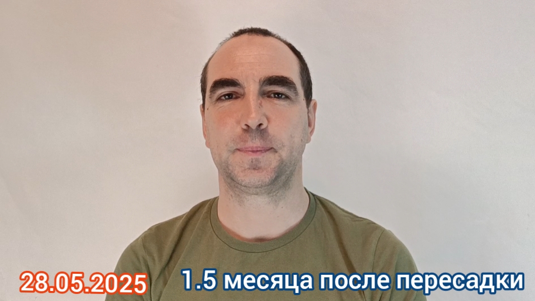 Пересадка волос. Ответы на вопросы. Как проходит восстановление.