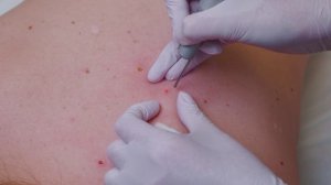 Удаление новообразований