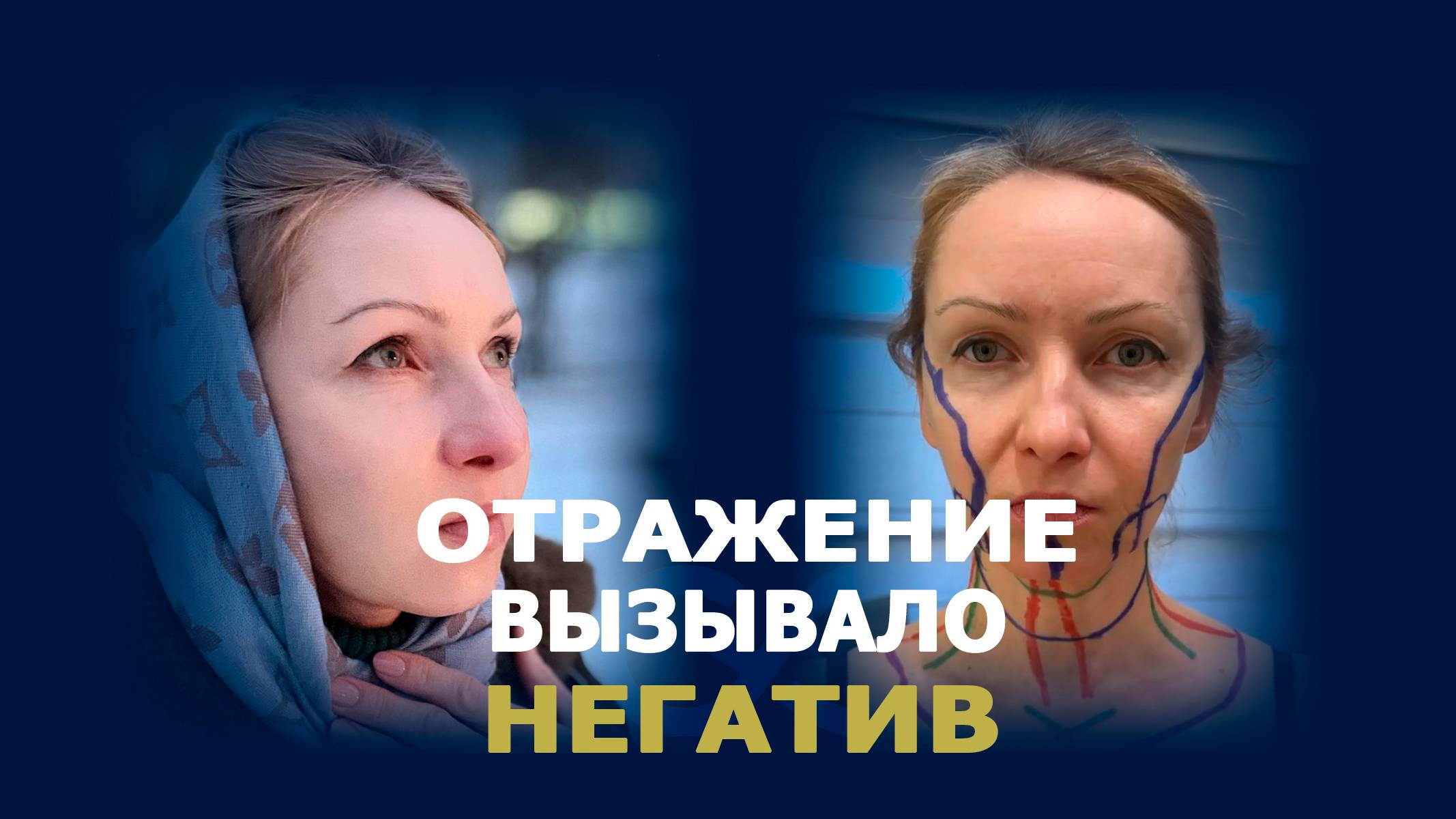 SMAS-лифтинг + платизмопластика: новая версия себя после 40