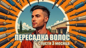 Пересадка волос спустя 3 месяца / Клиника GG Med