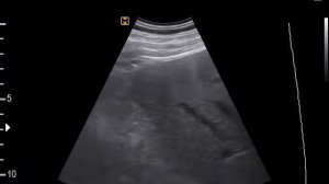 Очаговое образование правой почки( 6-7-17)