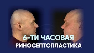 Пластика носа у мужчины после травм: до и через месяц