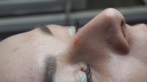 Удаление гемангиомы на лице.