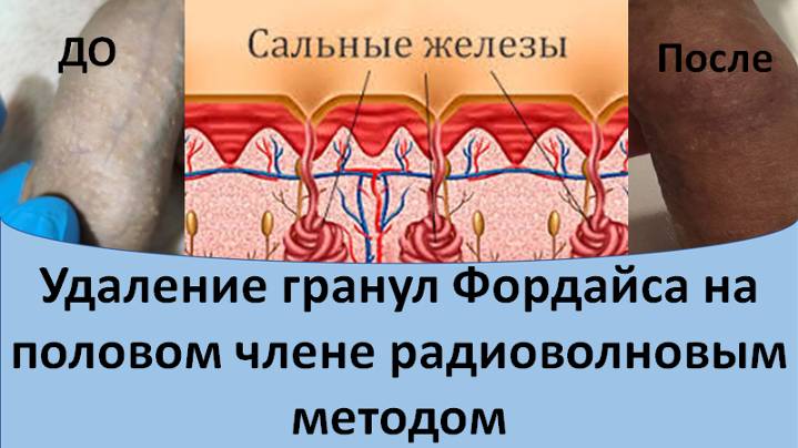 Удаление гранул Фордайса полового члена радиоволновым методом