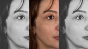 Нижняя блефаропластика с перемещением грыж: год после