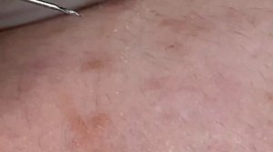 Выдавливание черных точек и прыщей 2023 Blackhead and Pimple Removal