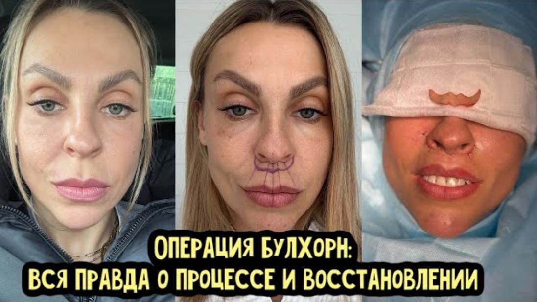 Френки Гонсалес. ПЛАСТИЧЕСКАЯ ОПЕРАЦИЯ БУЛХОРН. Мой личный опыт