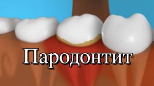 💥 Пародонтит