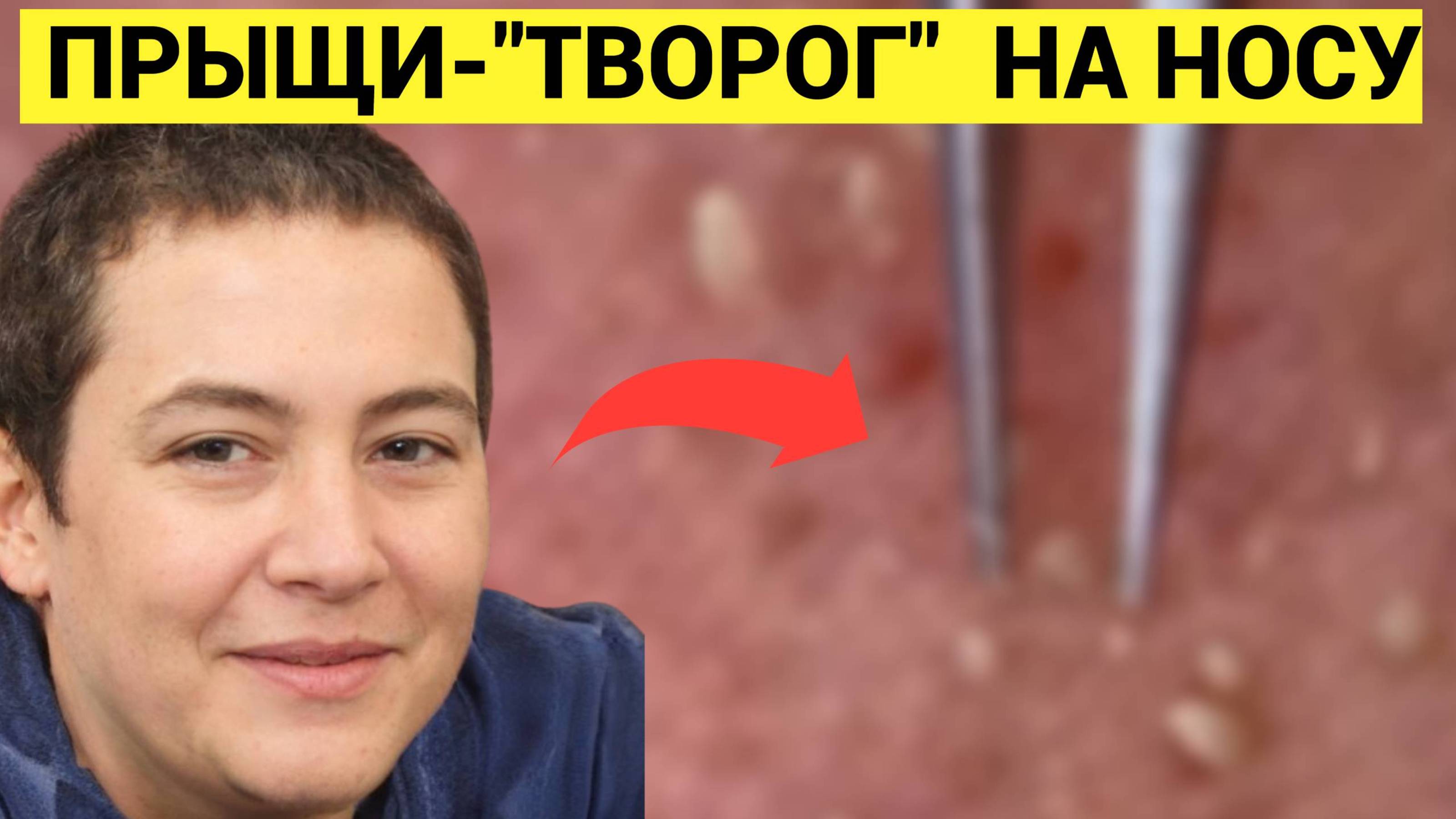 Стыдится Прыщей ТВОРОЖНЫХ на Носу Дядя. Надо вовремя к Косметологу просто ходить