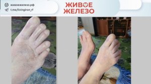 Трофические нарушения на ногах, стопа курильщика, микроциркуляция и Живое Железо для восстановления