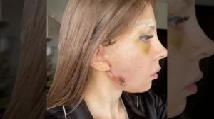 Медики не оставили на лице девушки ни одного целого участка. Стремление выглядеть моложе обернуло...