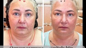 💥 ЛИШНИЙ ВЕС НЕ ПРИГОВОР ЛИЦУ И ШЕЕ!