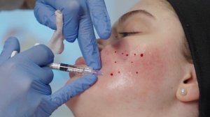 Коррекция рубцов постакне препаратом Viscoderm Hydrobooster.