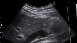 УЗИ печени - холедохолитиаз (конкремент в холедохе)