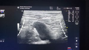 ЕЩЕ НЕСКОЛЬКО СЛОВ ПРО НАДКЛЮК
#узинавигация #сосудистыйдоступ #надклюк