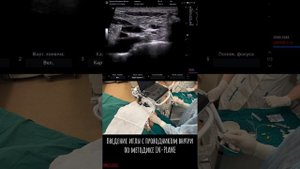 КАТЕТЕРИЗАЦИЯ ПОДКЛЮЧИЧНОЙ ВЕНЫ НАДКЛЮЧИЧНЫМ ДОСТУПОМ
#узинавигация #сосудистыйдоступ #надклюк